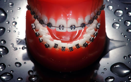 Multiband – feste Zahnspange